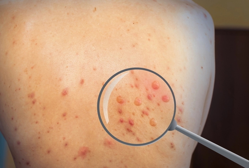 Vaccinazione contro il vaiolo delle scimmie